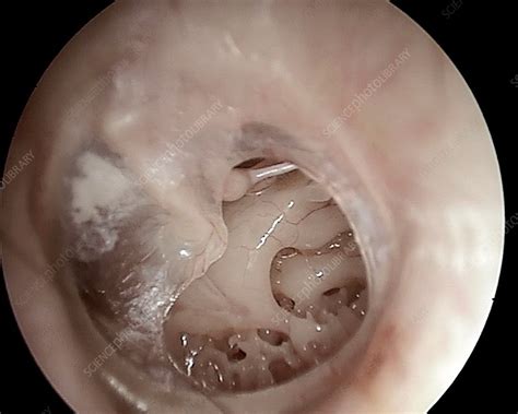 Ruptured eardrum (perforated eardrum) 